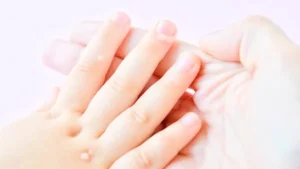 Quelles sont les causes des verrues sur les mains ?
